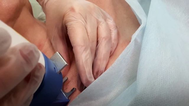 Лазером удаляем сосудистую сетку в зоне декольте.
