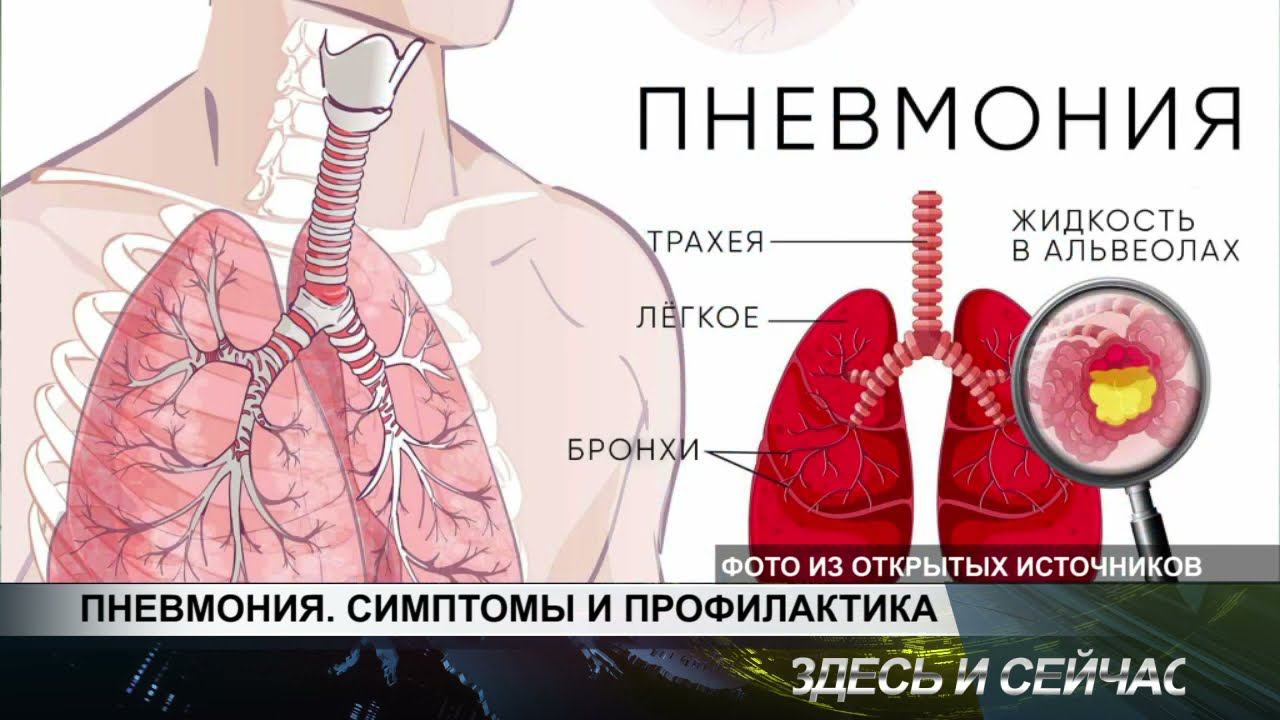 ПНЕВМОНИЯ СИМПТОМЫ И ПРОФИЛАКТИКА смотреть онлайн