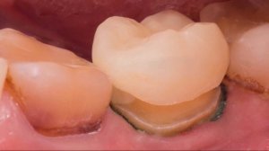 Teeth prep, препарирование зуба под керамическую коронку.  Коронка на зуб , керамические виниры