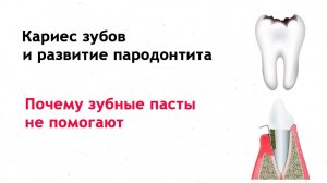 Кариес и пародонтит - почему зубные пасты не помогают; роль наследственности; полезные советы