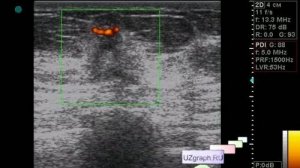 УЗИ молочных желез - Birads 5 (рак молочной железы на УЗИ)