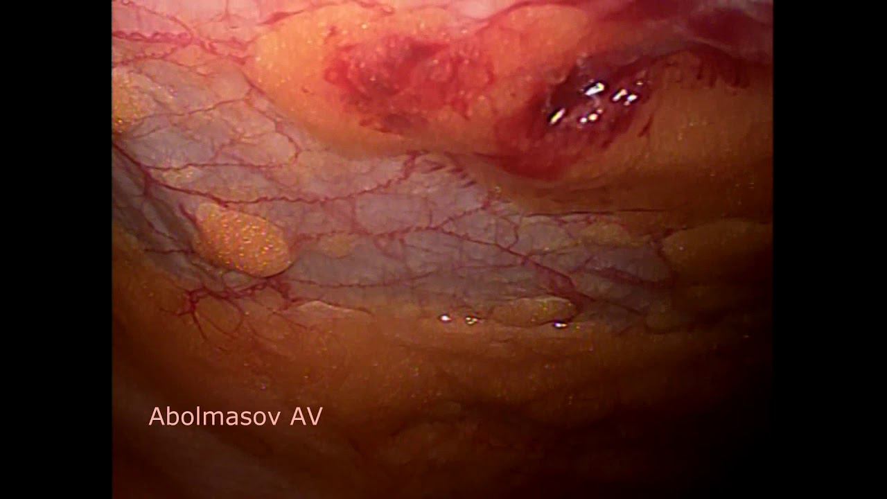 лапароскопическое подшивание матки и влагалища (non edited video) смотреть онлайн