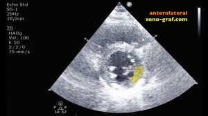 212 - Эхокардиография - Сегменты сердца