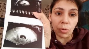 Беременность в 44года/ 7недель?/Кровотечение/Ретрохориальная гематома, что делать?!