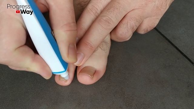 Мгновеннейший результат! Как быстро избавиться за 3 минуты от грибка на ногах! Дешево и сердито! смотреть онлайн