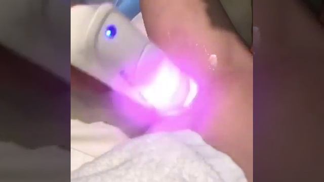 MBT - Honor ice диодный лазер смотреть онлайн