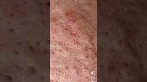 ПРИЯТНОЕ ВЫДАВЛИВАНИЕ ЧЕРНЫХ ТОЧЕК НА ЩЕКАХ