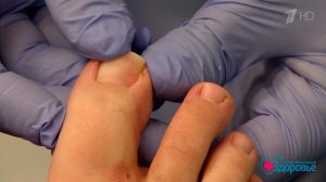 Вросший ноготь на большом пальце. Здоровье. Фрагмент выпуска от 10.09.2017