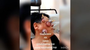 Хиджама бетке, хиджама на лицо