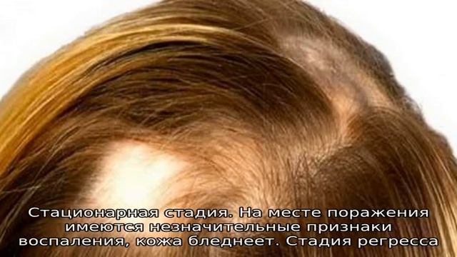 Причины и лечение очаговой (гнездной) алопеции