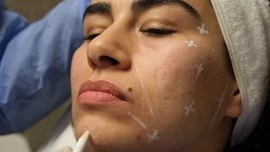 Jalupro V-Lift Super Hydro Uygulama - Op.Dr. Başar Kaya