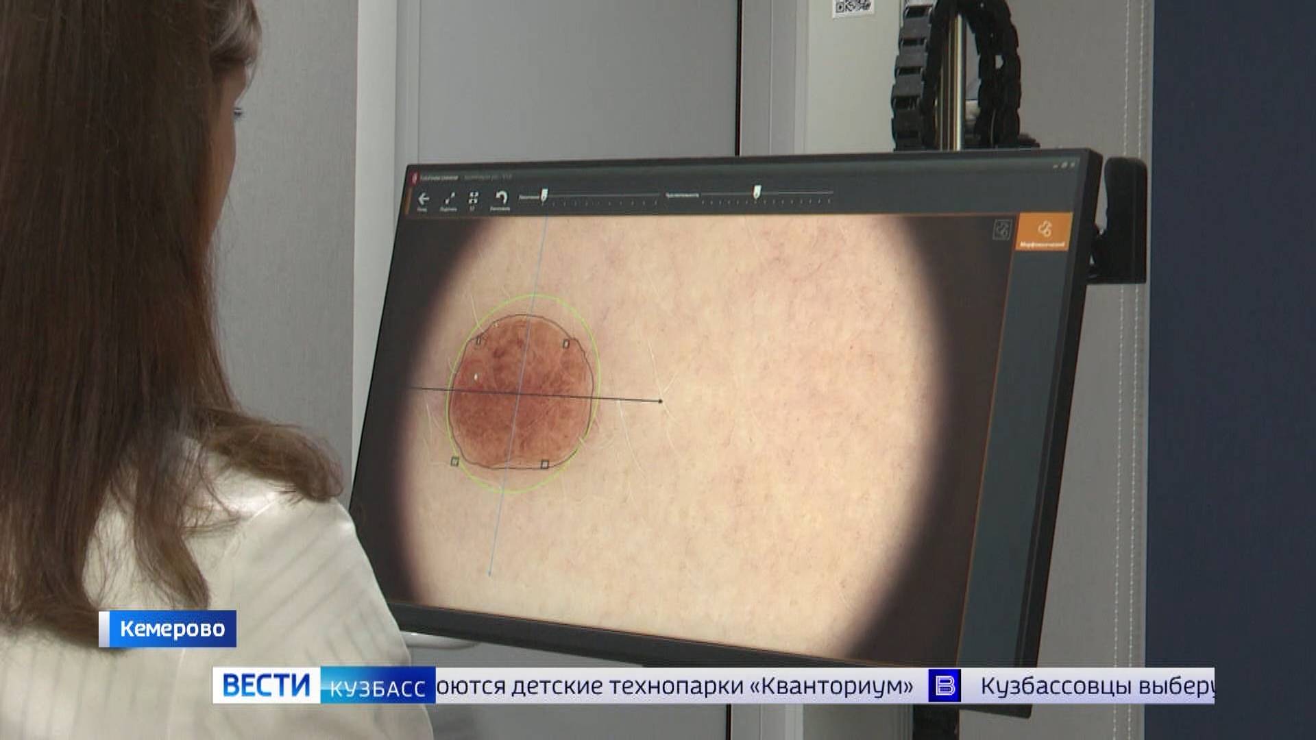 Опасная родинка: в Кузбасском кожвендиспансере используют современное оборудование для диагностики