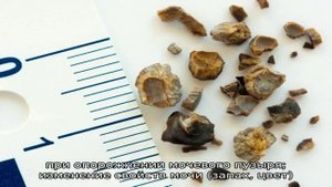 Пиелокаликоэктазия – расширение чашечно-лоханочной системы почек