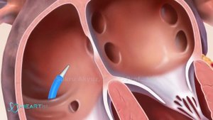 Repairing a Leaky Heart Valve without Surgery: Mitral Valve Clip (MitraClip)