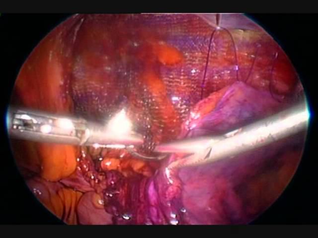 Грыжа паховая - лапароскопическая ТАПП Аболмасов А,В. смотреть онлайн