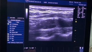 Практическое занятие. Стеноз левой ВСА (О.Л. Ерошенко)