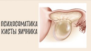 Психосоматика кисты яичника – киста яичника и ее настоящие причины.