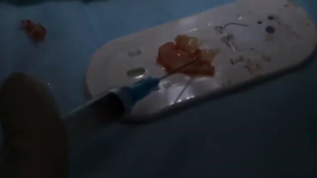 Ринопластика с применением клея СУЛЬФАКРИЛАТ