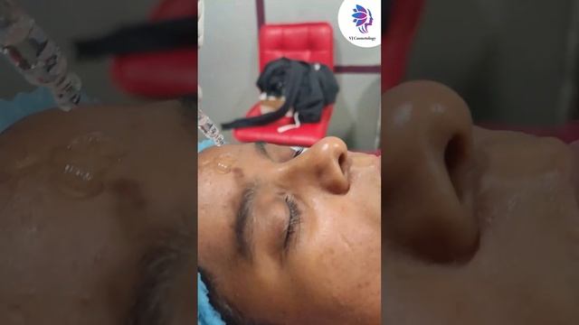 Best Treatment for Open Pores: Micro-Needling | Vj’s cosmetology clinic смотреть онлайн