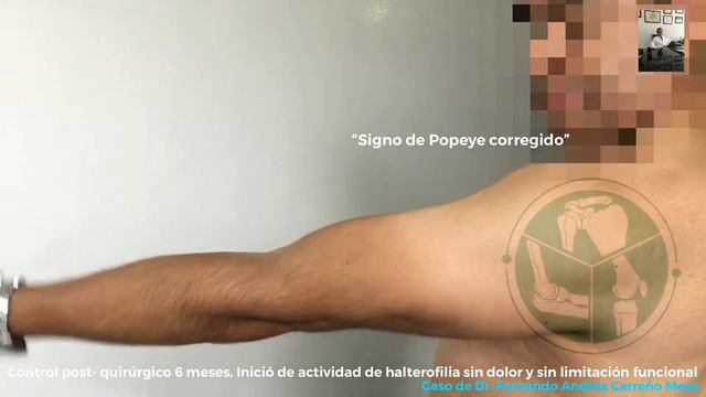 VIDEO COMPLETO CASO 2: REINSERCIÓN- TENODESIS DE RUPTURA CRÓNICA DE BICEPS PROXIMAL смотреть онлайн