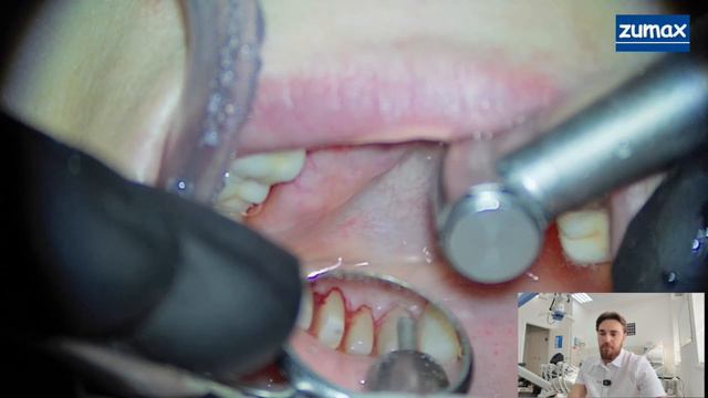 СТОМБУДНИ#40 САМЫЙ БЫСТРЫЙ ВЕРТИПРЕП С "КЕТЧУПОМ" И ОТТИСК смотреть онлайн