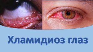 Хламидиоз глаз.
