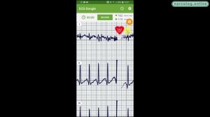 Тест обзор.  ЭКГ vs  Garmin HRM RUN