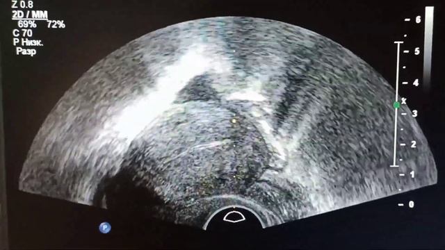 киста яичника? жёлтое тело? ovarian cyst?  yellow body?