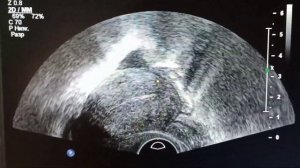 киста яичника? жёлтое тело? ovarian cyst?  yellow body?