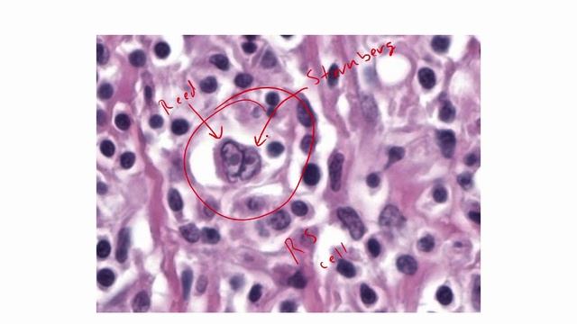 USMLE RX - 5.Гематология и онкология - 2.Патология - 5.Лимфома Ходжкина