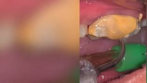 Чистка Зубного Камня | How to Remove Tartar from Teeth