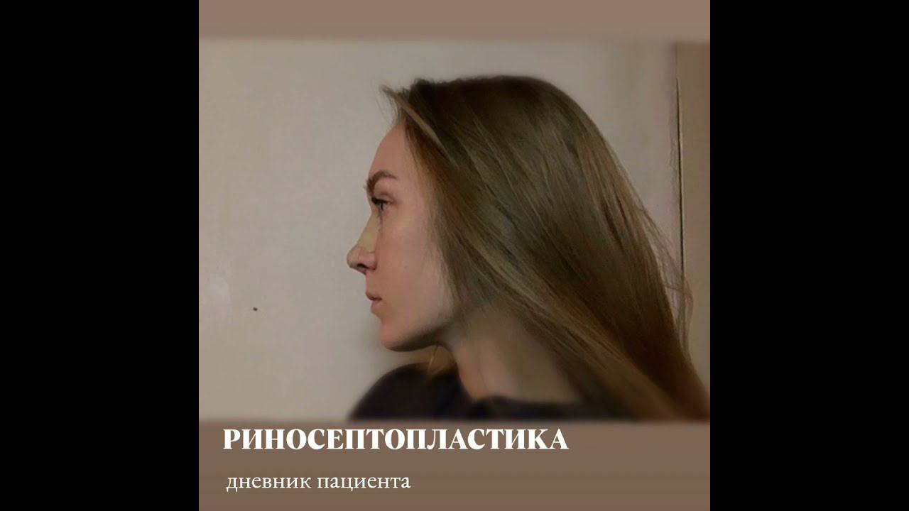 Дневник после ринопластики