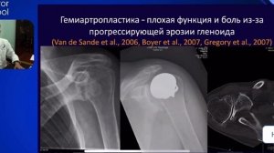 Вебинар на тему "Хирургическое лечение пациента с РА. Подводные камни", к.м.н. Максим А. Макаров