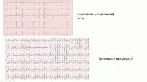 Советы кардиолога: ЭКГ. Учимся читать