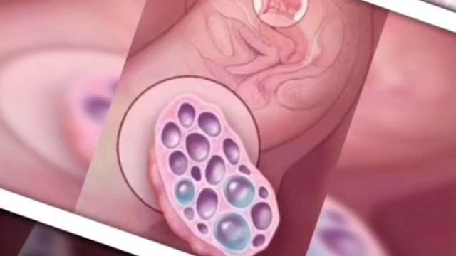 MULTIFOLLIKULALI TUXUMDON VA UNI DAVOLASH VA HOMIL смотреть онлайн