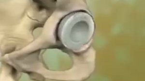 Анимация по эндопротезированию тазобедренного сустава