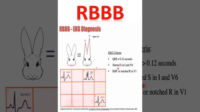 RBBB|Right bundle branch block|ECG interpretation #ecg