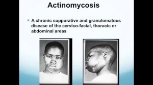 الاكتنومايسيز والنوكارديه actinomyces and nocardia