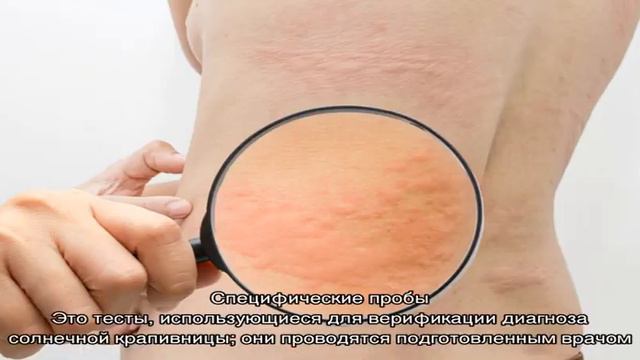 Все о солнечной крапивнице
