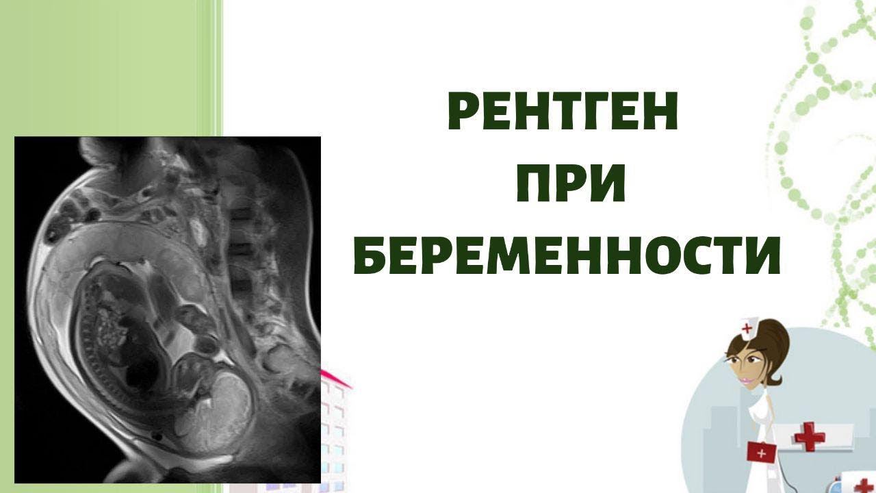 Рентген при беременности!!!! Можезо ли рентген при беременности?Когда и зачем назначают рентген! смотреть онлайн