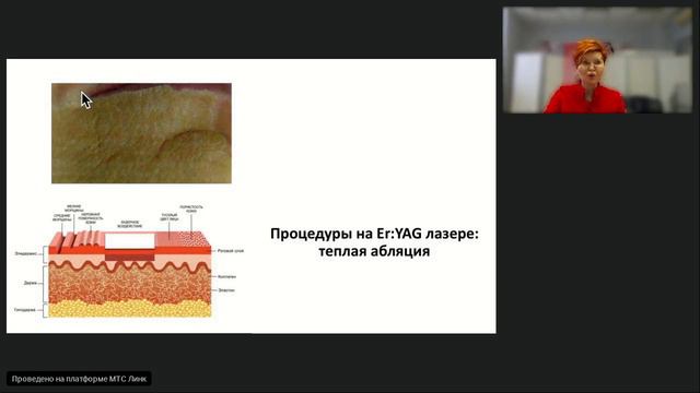 Вебинар 22.11.23. Абляция Fotona