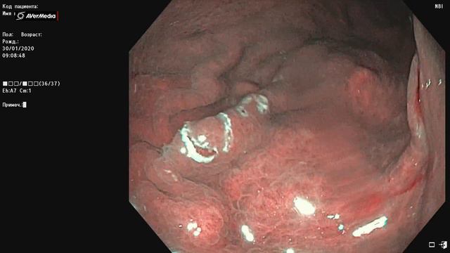 Неоплазия желудка, гистология - LGD. смотреть онлайн