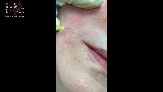 Как избавиться от морщин - техника бланширования смотреть онлайн