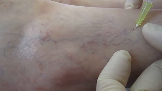 Удаление сосудистых звездочек смотреть онлайн