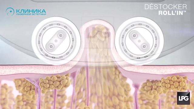 LPG массаж на оригинальном аппарате или на подделке , есть ли разница ? смотреть онлайн