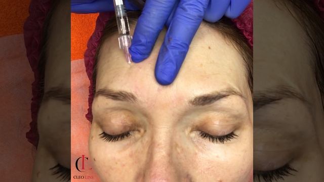 Контурная пластика в технике Бланширование смотреть онлайн