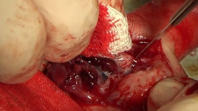 Удаление образования пальца кисти