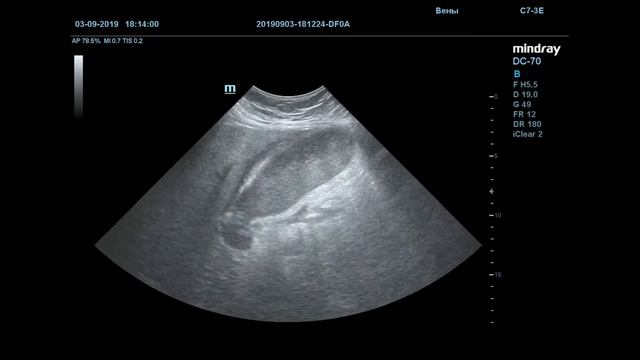 Острый холецистит макропрепарат