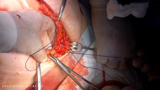 Ушивание лапаротомии смотреть онлайн