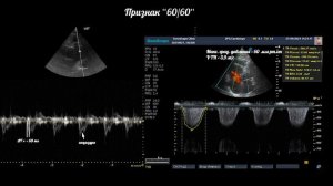 Тромбоэмболия легочной артерии (ТЭЛА) на эхокардиографии